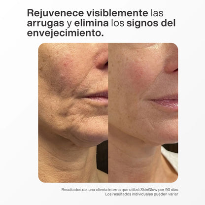 Skin Glow™ - Varita Rejuvenecedora de Luz Roja 4-en-1